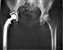 746px-Hip_replacement_Image_3684-PH.jpg